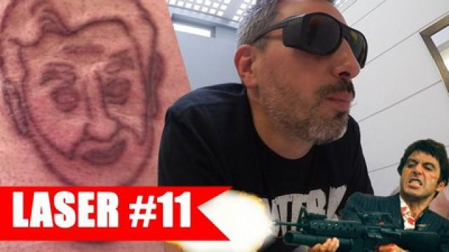 Détatouage laser #11 : On y va à la mitraillette