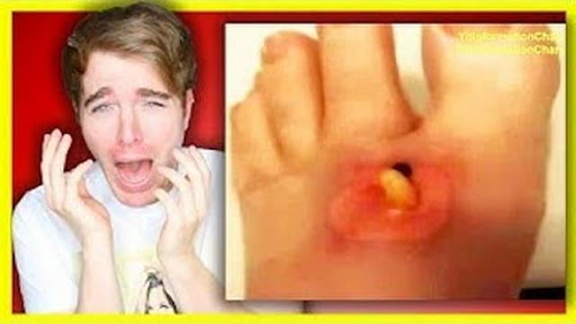 REACTING TO BOTFLY MAGGOT REMOVAL