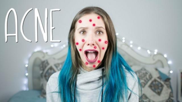 Minha experiência com Roacutan | Gabbie Fadel