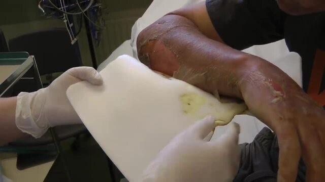GETTING BURNT,POPPING BLISTERS,PEELING OF MY OWN SKIN