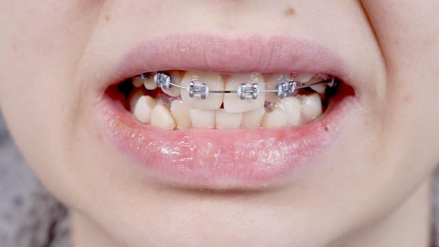 Pourquoi a-t-on les dents tordues ?