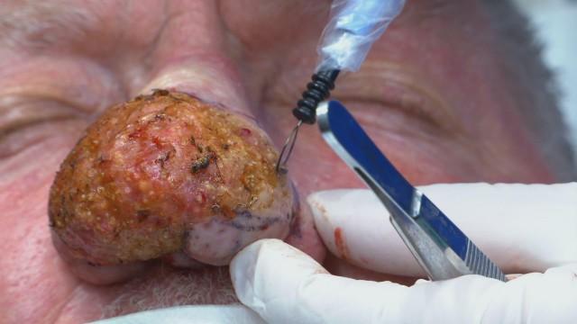 Lessons in Pimple Popping
