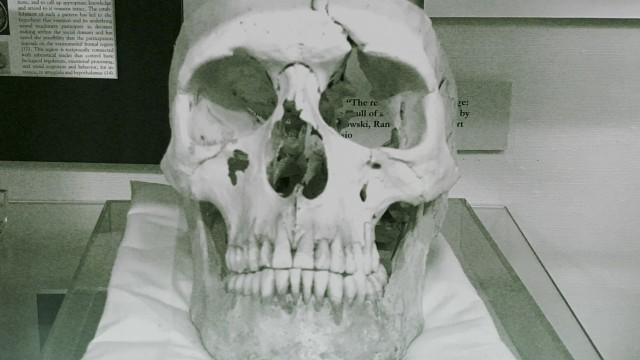 Phineas Gage's Skull